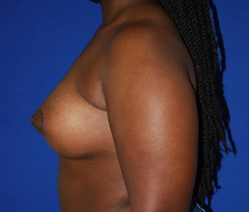 Augmentation Before & After Gallery - Patient 309572 - Image 6