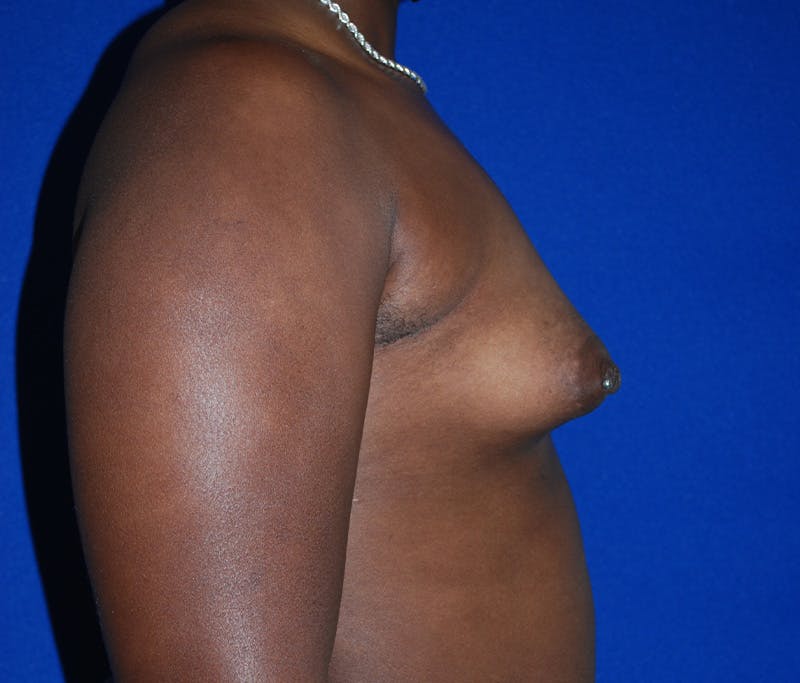 Augmentation Before & After Gallery - Patient 309572 - Image 3