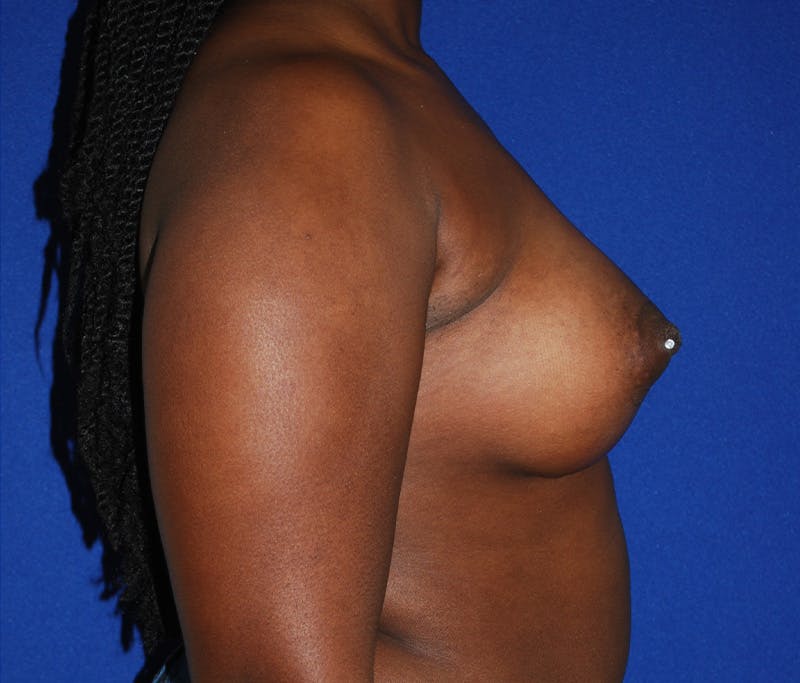 Augmentation Before & After Gallery - Patient 309572 - Image 4