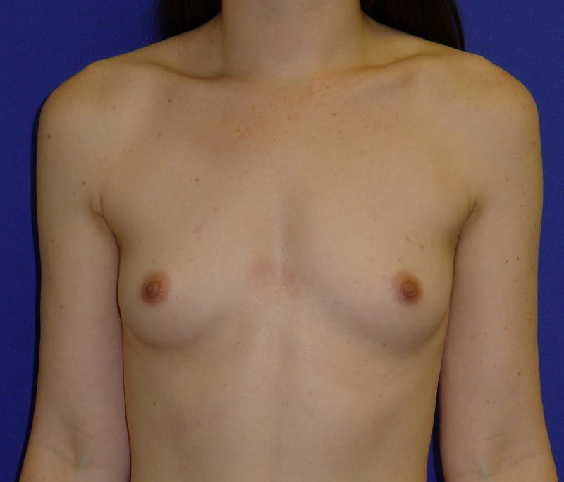 Augmentation Before & After Gallery - Patient 538205 - Image 1