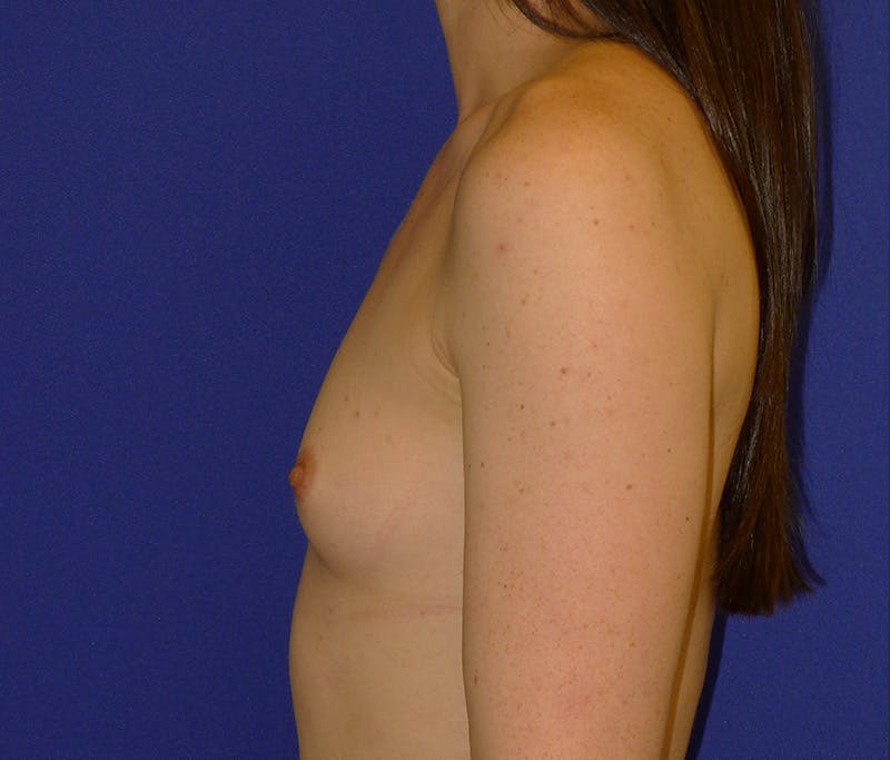 Augmentation Before & After Gallery - Patient 538205 - Image 5