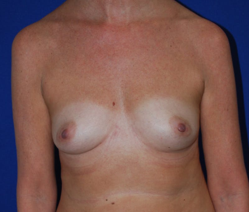 Augmentation Before & After Gallery - Patient 227776 - Image 1