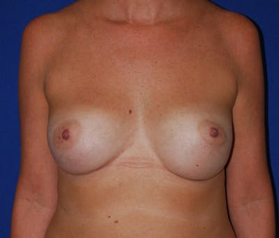 Augmentation Before & After Gallery - Patient 227776 - Image 2
