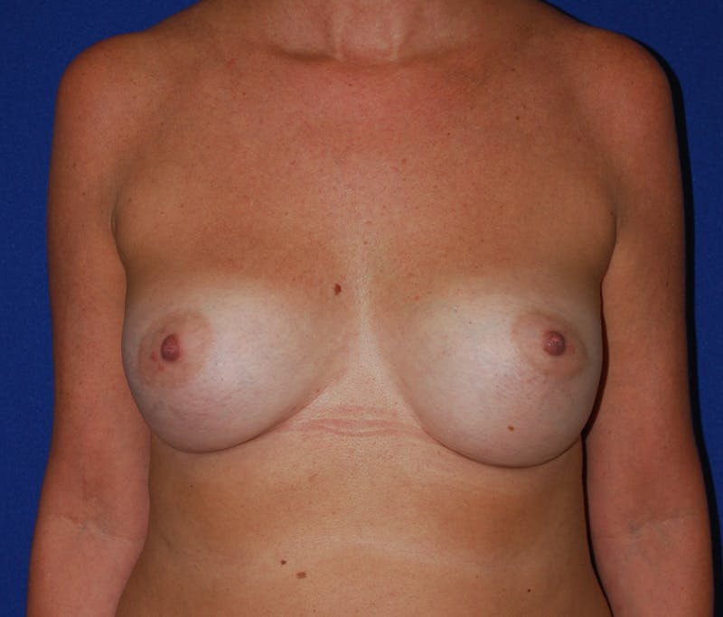 Augmentation Before & After Gallery - Patient 227776 - Image 2