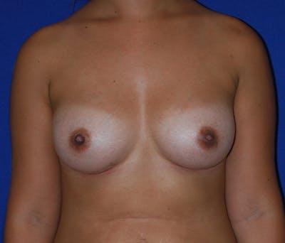 Augmentation Before & After Gallery - Patient 218502 - Image 2
