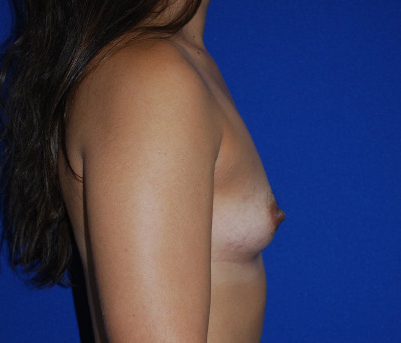 Augmentation Before & After Gallery - Patient 218502 - Image 3