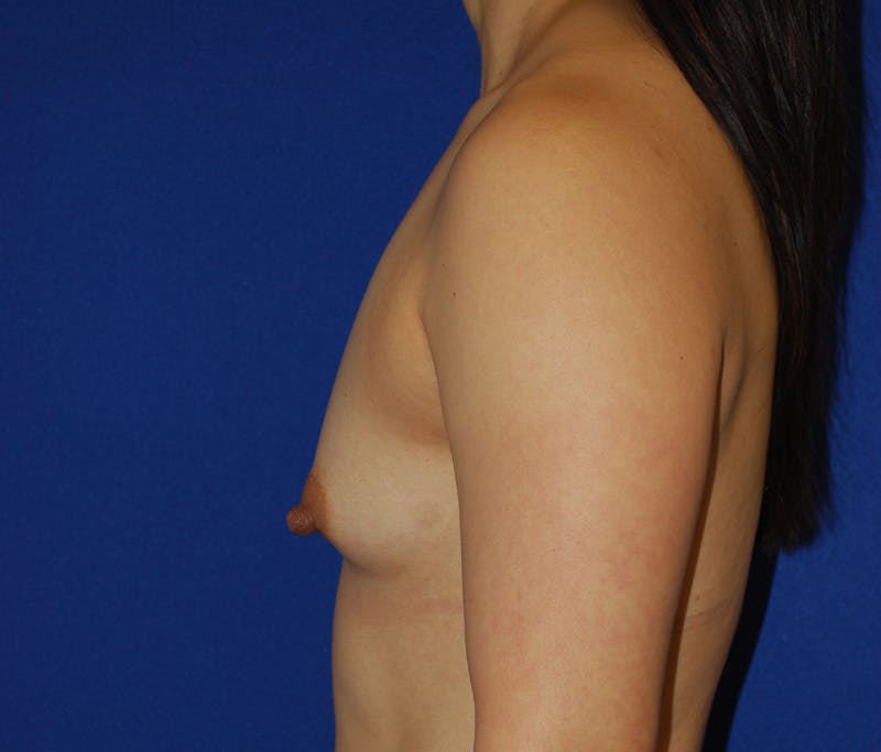 Augmentation Before & After Gallery - Patient 414665 - Image 5