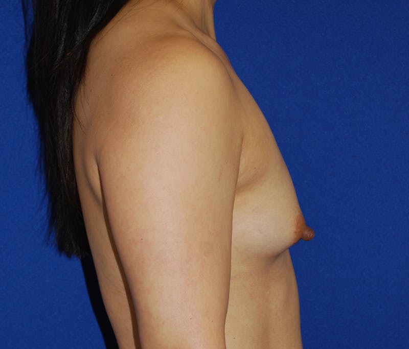 Augmentation Before & After Gallery - Patient 414665 - Image 3