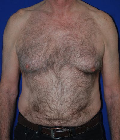 Gynecomastia Before & After Gallery - Patient 415511 - Image 1