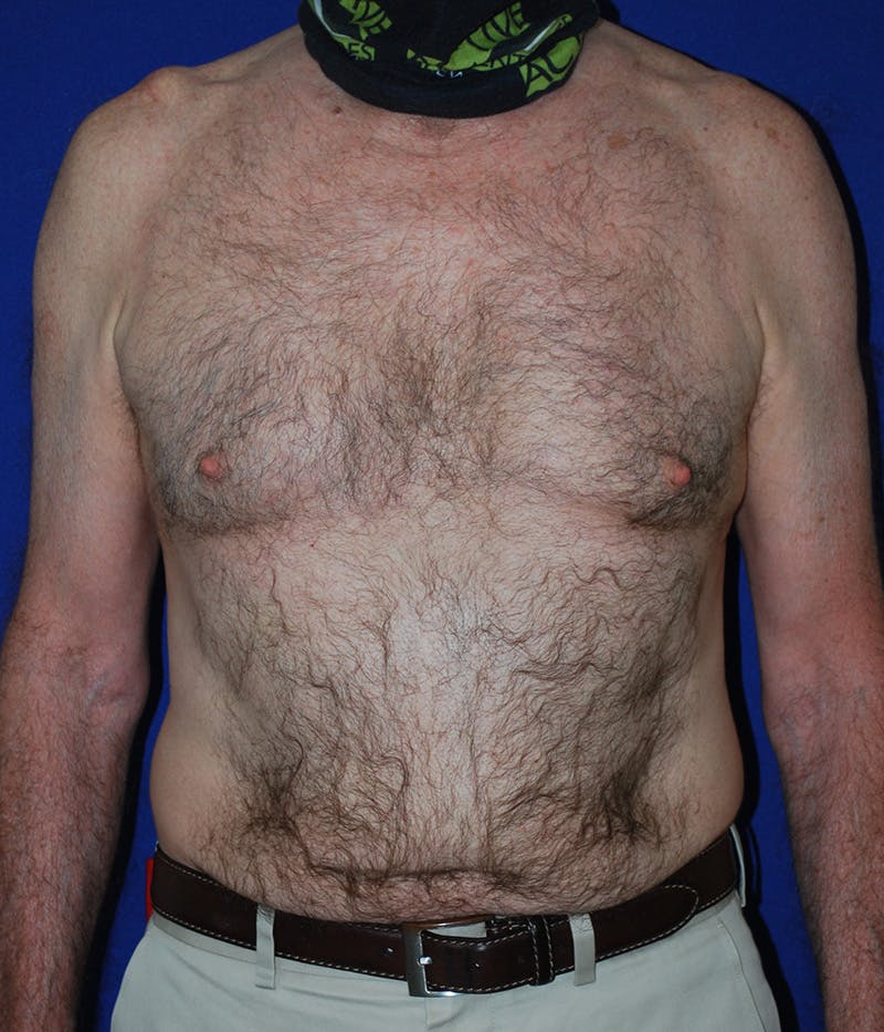 Gynecomastia Before & After Gallery - Patient 415511 - Image 2