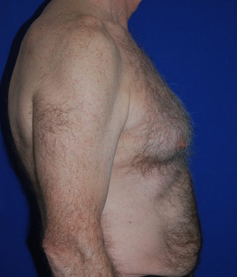 Gynecomastia Before & After Gallery - Patient 415511 - Image 3