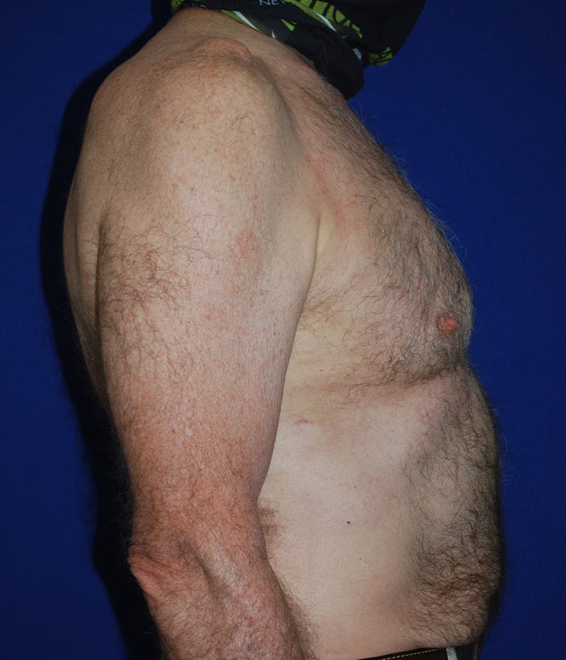 Gynecomastia Before & After Gallery - Patient 415511 - Image 4