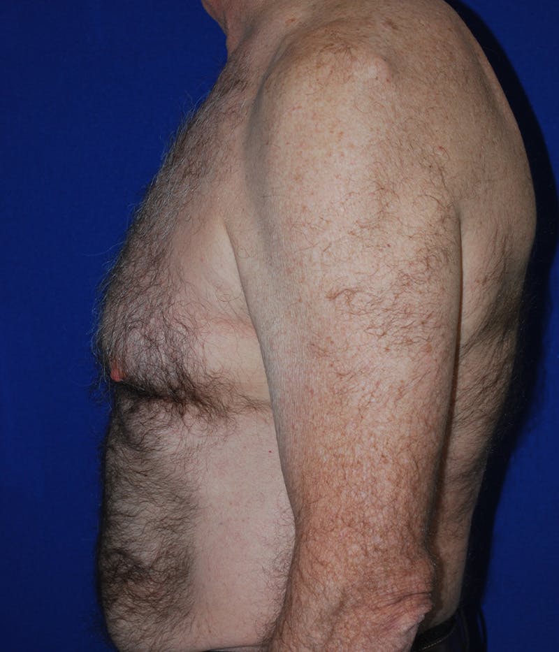 Gynecomastia Before & After Gallery - Patient 415511 - Image 5