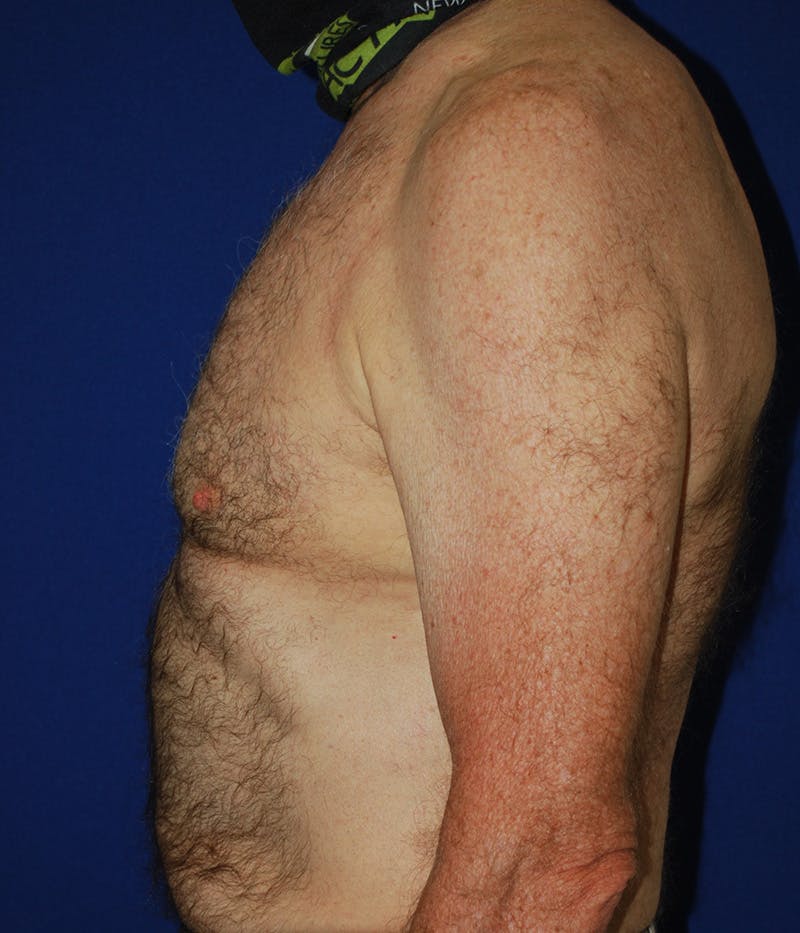 Gynecomastia Before & After Gallery - Patient 415511 - Image 6