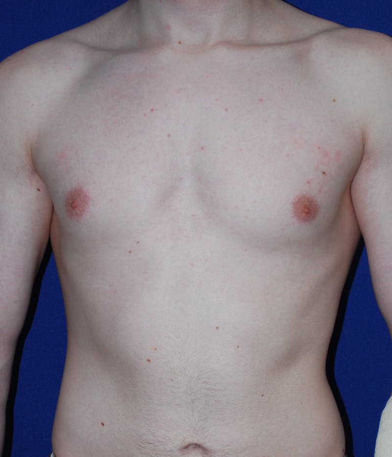 Gynecomastia Before & After Gallery - Patient 386189 - Image 1