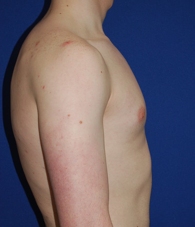 Gynecomastia Before & After Gallery - Patient 386189 - Image 3