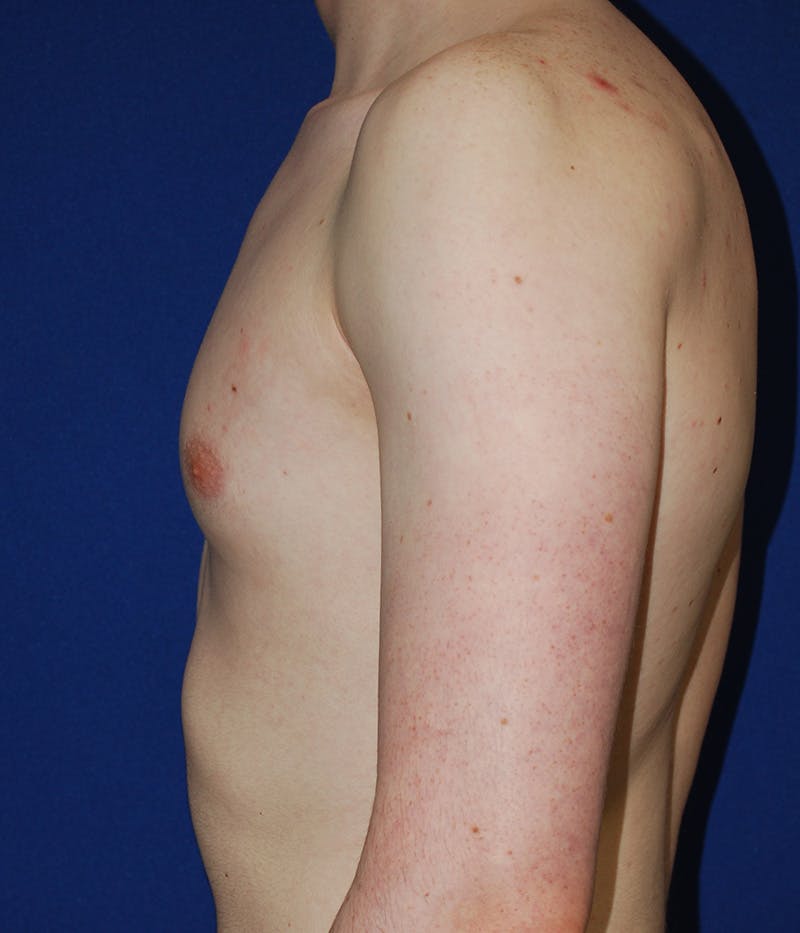 Gynecomastia Before & After Gallery - Patient 386189 - Image 5