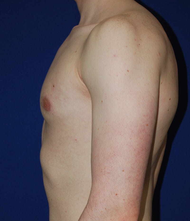 Gynecomastia Before & After Gallery - Patient 386189 - Image 6