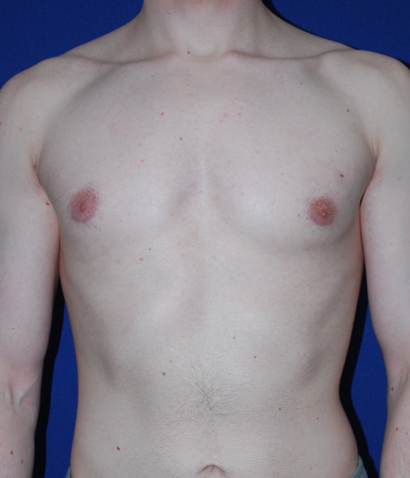 Gynecomastia Before & After Gallery - Patient 386189 - Image 2