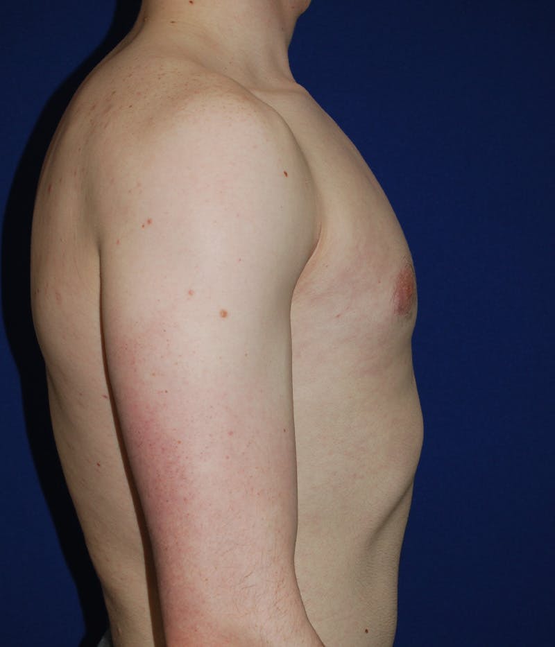 Gynecomastia Before & After Gallery - Patient 386189 - Image 4