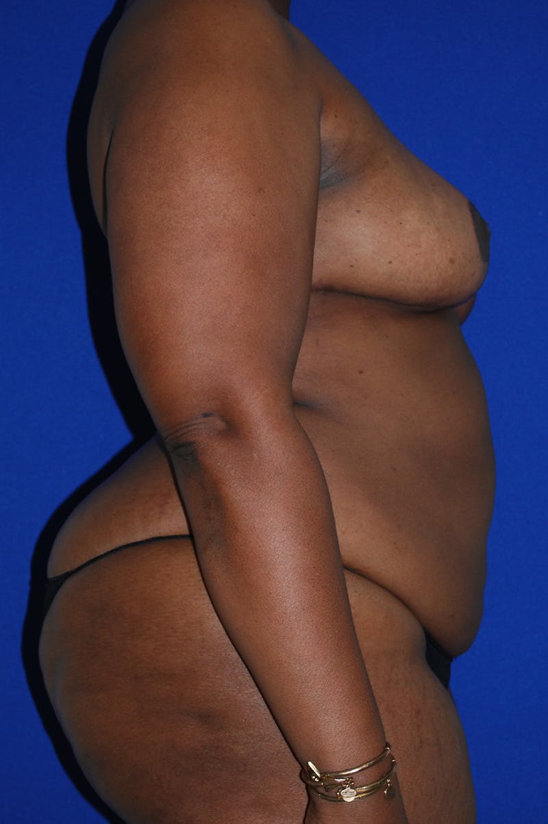 Abdominoplasty Before & After Gallery - Patient 341849 - Image 3