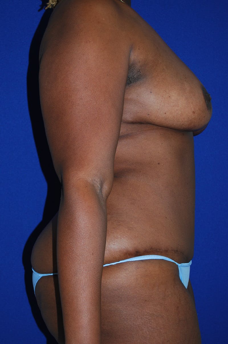Abdominoplasty Before & After Gallery - Patient 341849 - Image 4