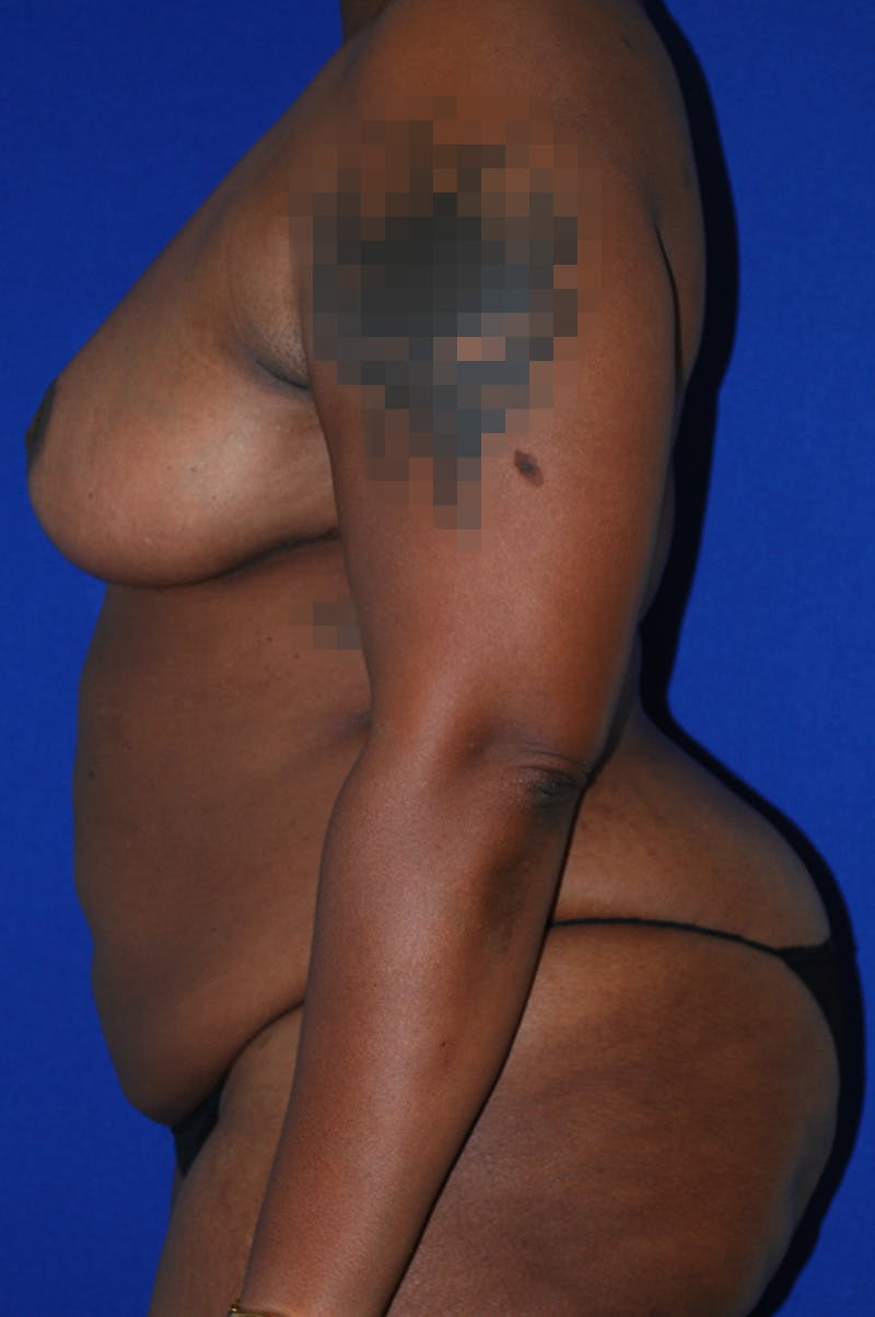 Abdominoplasty Before & After Gallery - Patient 341849 - Image 5