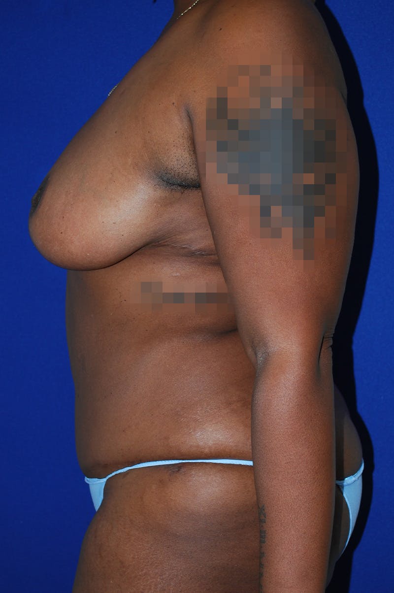 Abdominoplasty Before & After Gallery - Patient 341849 - Image 6