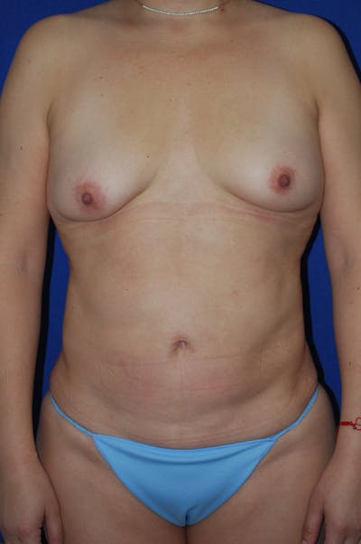 Augmentation Before & After Gallery - Patient 212370 - Image 1