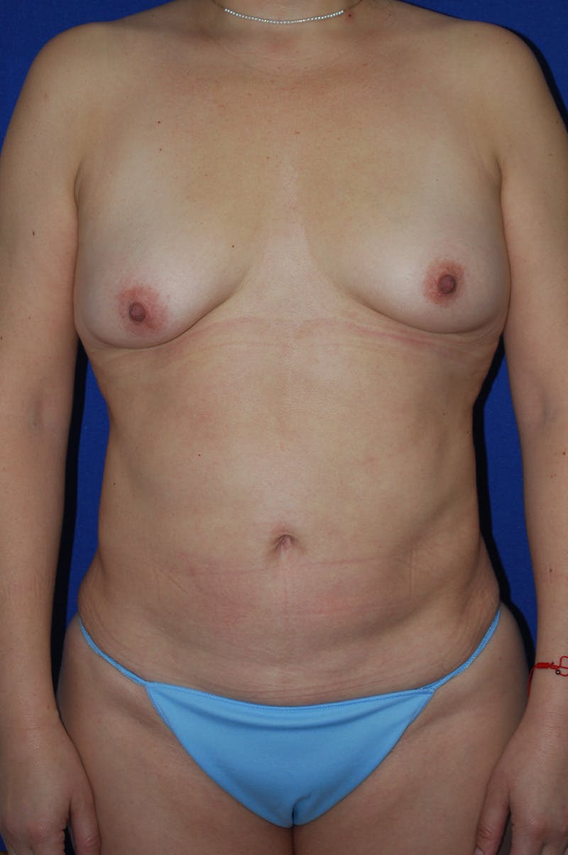 Mommy Makeover Before & After Gallery - Patient 194126 - Image 1