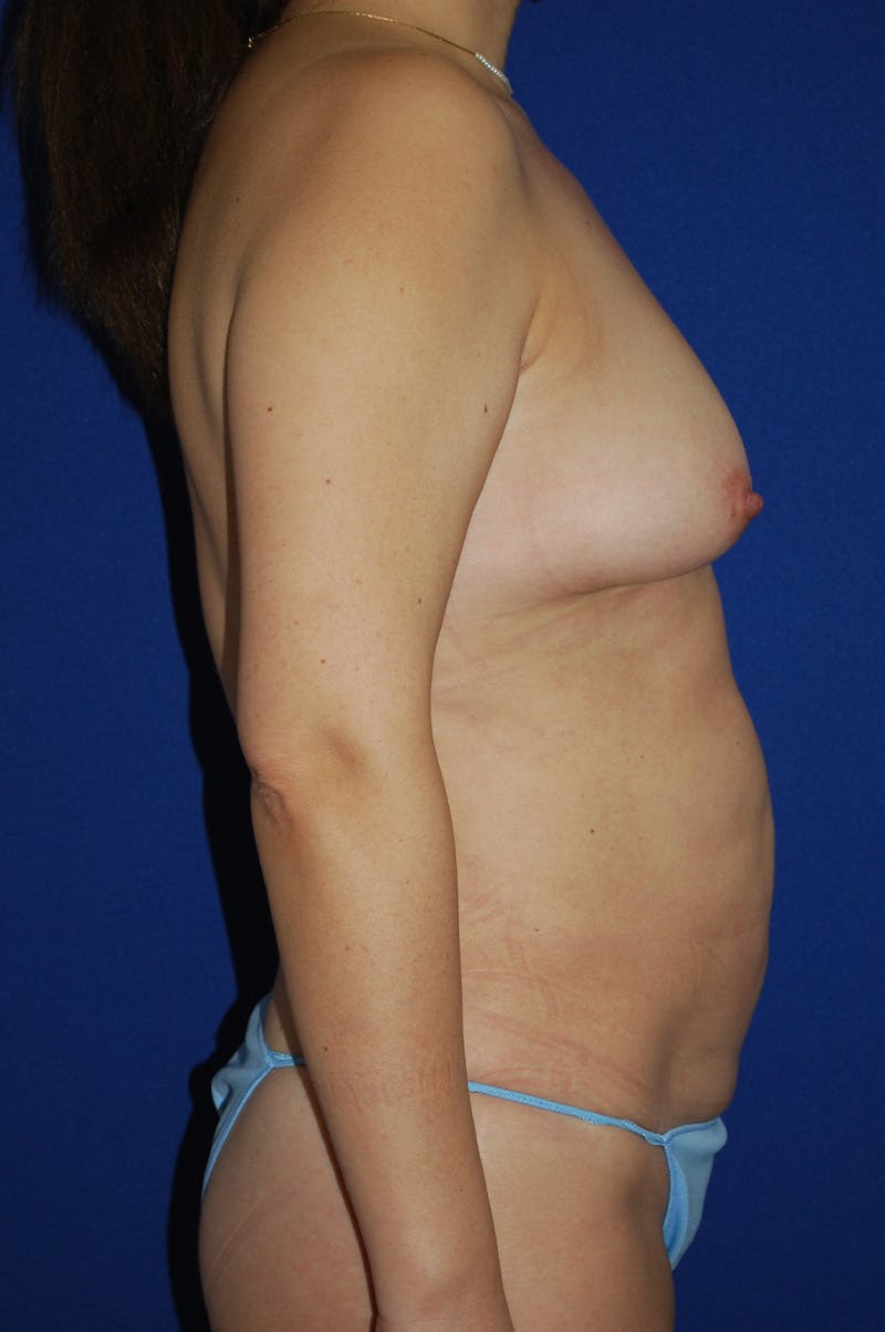 Mommy Makeover Before & After Gallery - Patient 194126 - Image 3