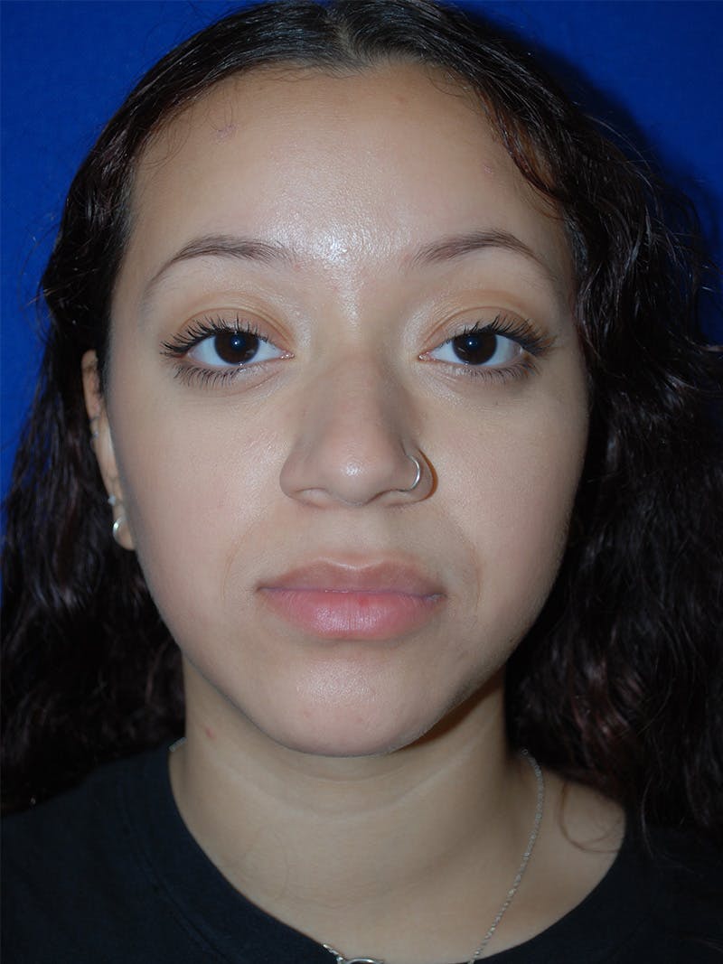 Rhinoplasty Before & After Gallery - Patient 355778 - Image 3