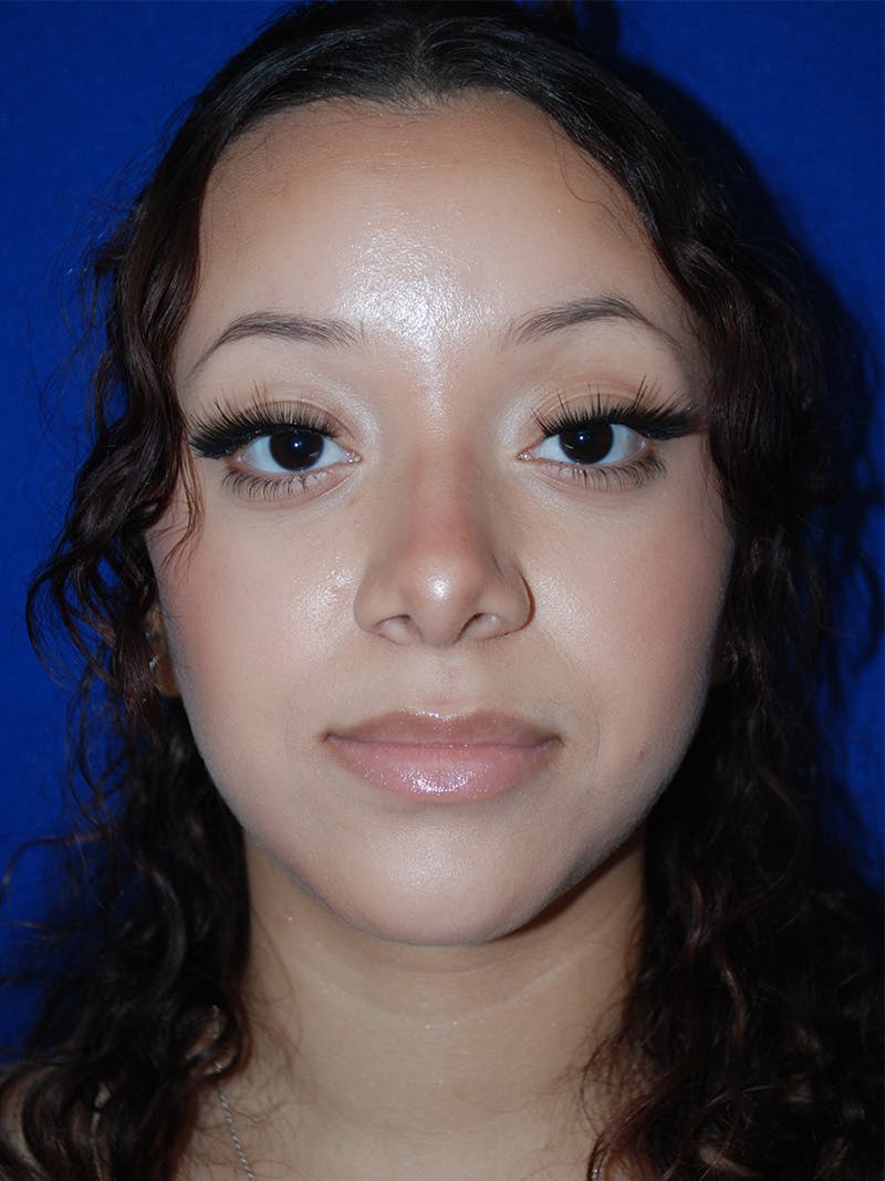 Rhinoplasty Before & After Gallery - Patient 355778 - Image 4
