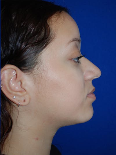 Rhinoplasty Before & After Gallery - Patient 355778 - Image 1