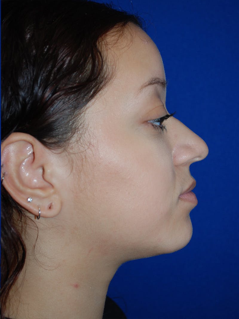 Rhinoplasty Before & After Gallery - Patient 355778 - Image 1