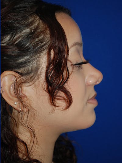 Rhinoplasty Before & After Gallery - Patient 355778 - Image 2