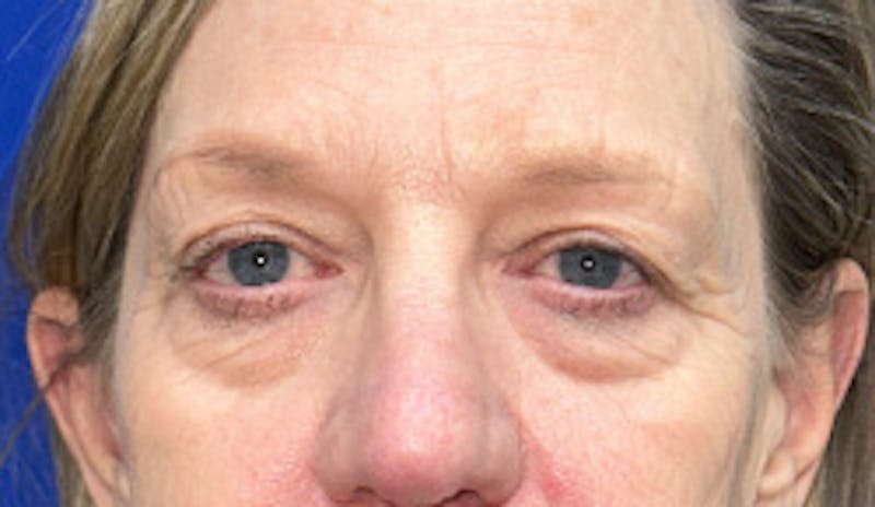 Blepharoplasty Before & After Gallery - Patient 333060 - Image 1