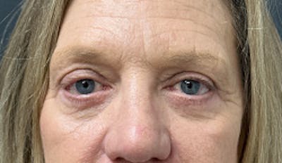 Blepharoplasty Before & After Gallery - Patient 333060 - Image 2