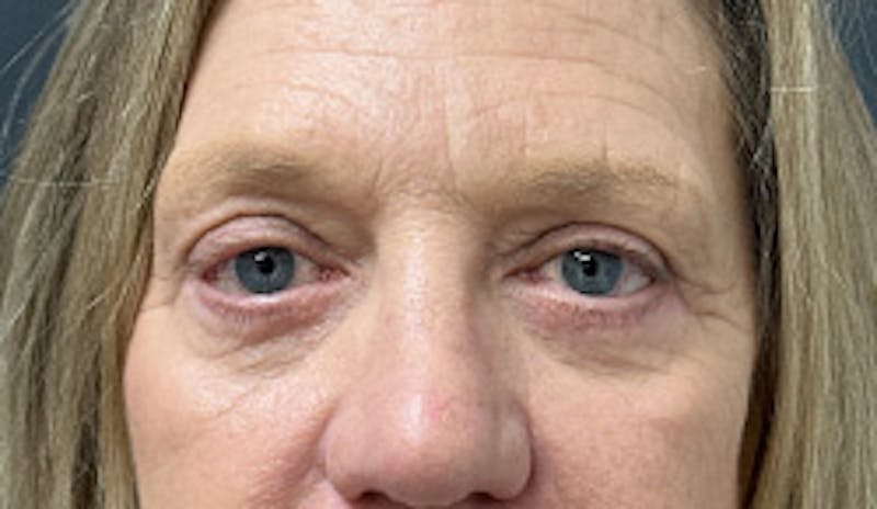 Blepharoplasty Before & After Gallery - Patient 333060 - Image 2