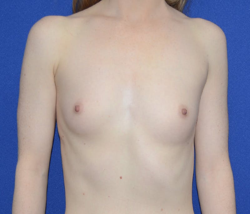 Augmentation Before & After Gallery - Patient 641418 - Image 1