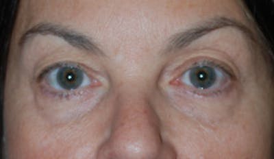 Blepharoplasty Before & After Gallery - Patient 175173321 - Image 1