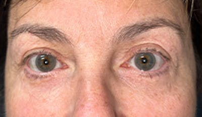 Blepharoplasty Before & After Gallery - Patient 175173321 - Image 2
