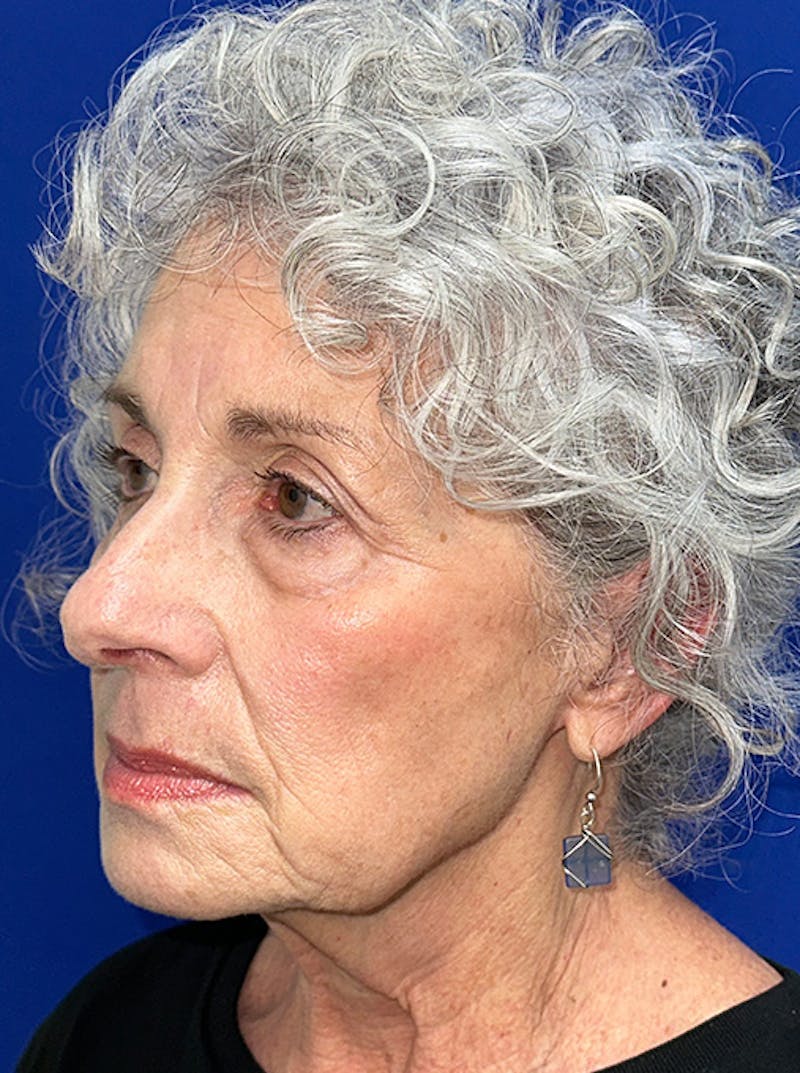 Neck Lift Before & After Gallery - Patient 187551 - Image 7