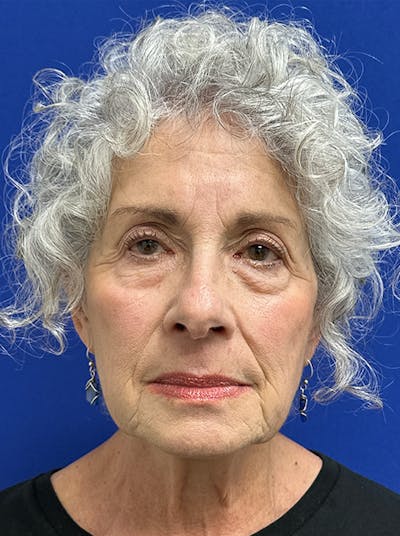 Neck Lift Before & After Gallery - Patient 187551 - Image 1
