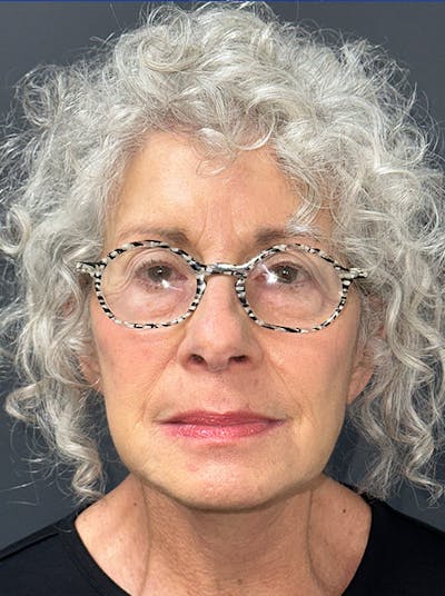 Neck Lift Before & After Gallery - Patient 187551 - Image 2