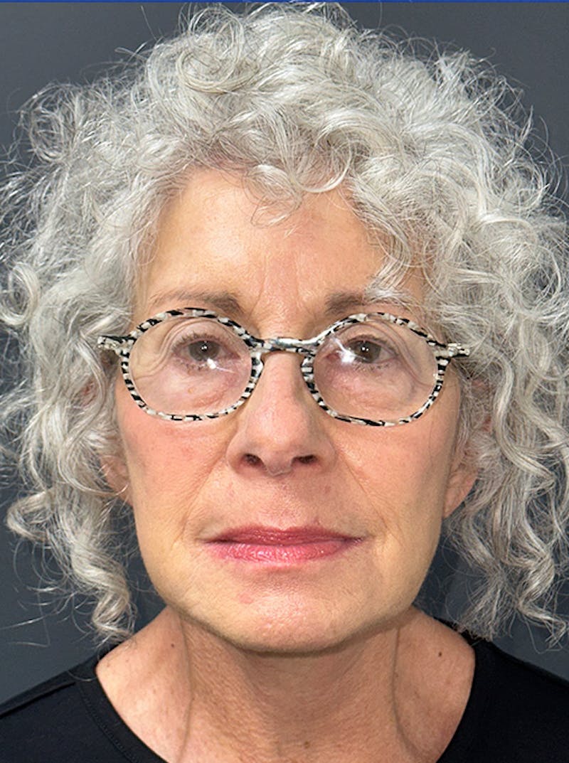 Neck Lift Before & After Gallery - Patient 187551 - Image 2
