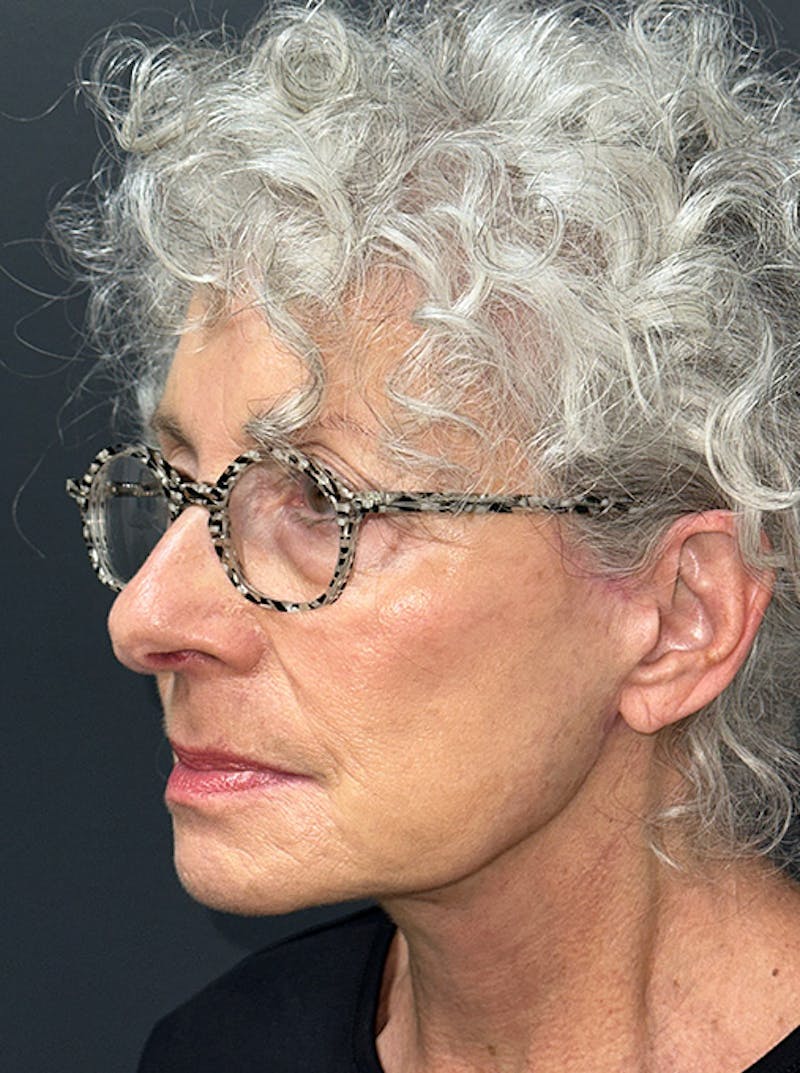 Neck Lift Before & After Gallery - Patient 187551 - Image 8