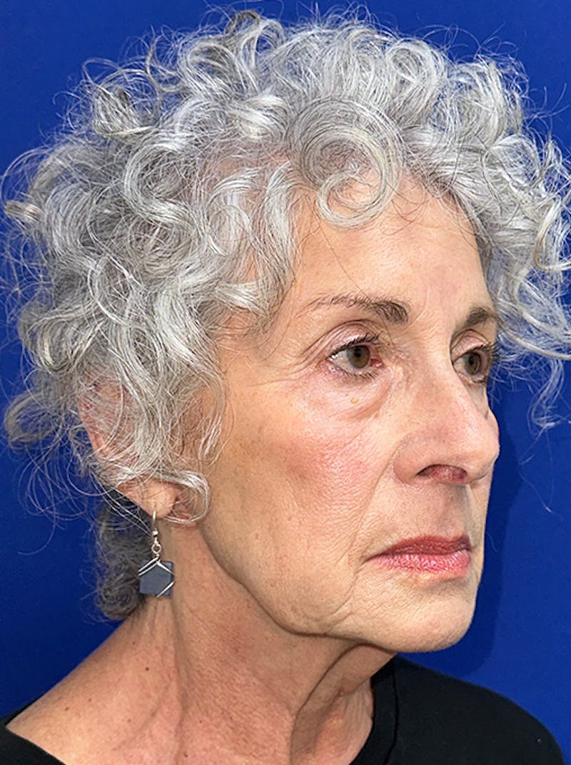 Neck Lift Before & After Gallery - Patient 187551 - Image 3