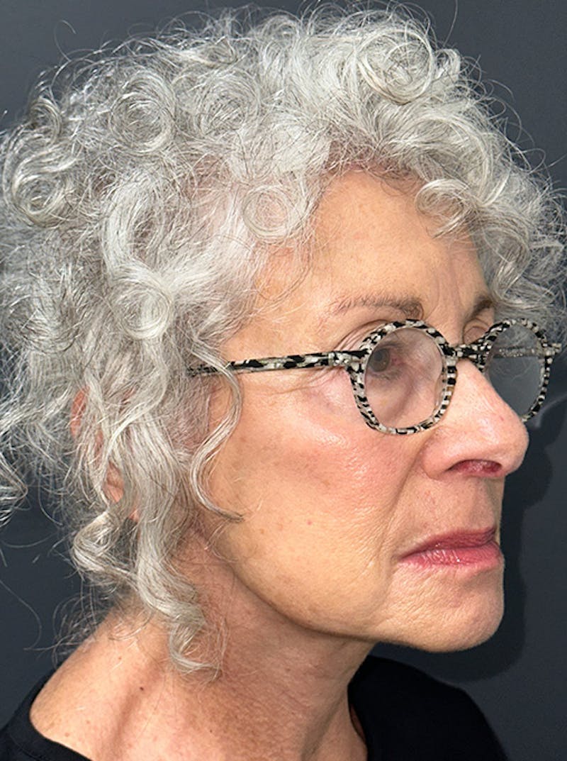 Neck Lift Before & After Gallery - Patient 187551 - Image 4