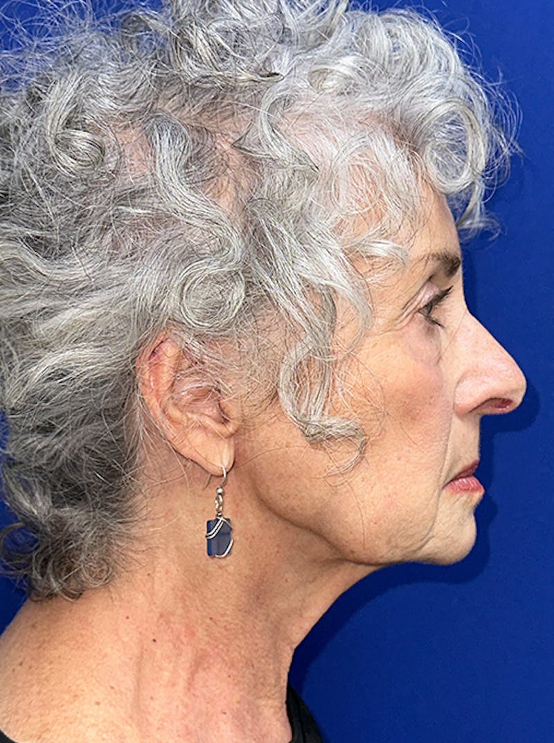 Neck Lift Before & After Gallery - Patient 187551 - Image 5